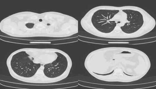动态胸部CT影像 肺部CT影像 腹部CT高清在线视频素材下载
