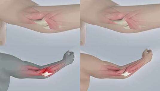 风湿骨病 骨折 胳膊疼 肌肉酸痛高清在线视频素材下载