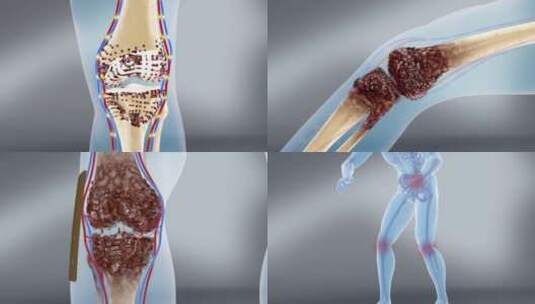 人体风寒湿邪 骨关节疾病 滋养骨骼高清在线视频素材下载