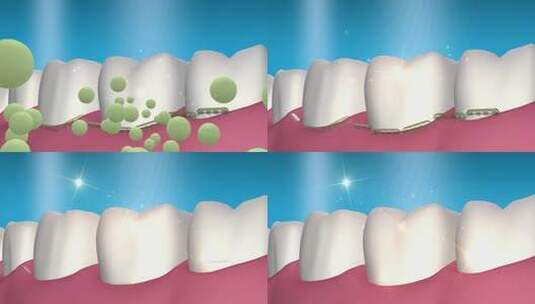AE模板 4K牙菌斑清洁广告高清AE视频素材下载