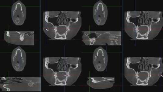 口腔CBCT 冠状位CT 头部CT 查看报告高清在线视频素材下载