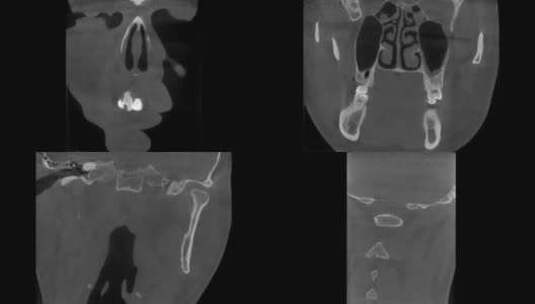 头部CT 冠状位 口腔CBCT高清在线视频素材下载