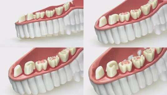 牙齿模型展示及牙齿疾病示意高清在线视频素材下载