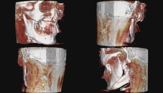 口腔CBCT 轴位 头像3D 牙齿三维高清在线视频素材下载