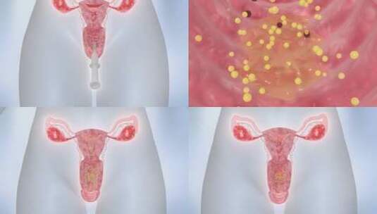 女性妇科 铲除细菌 毒垢宫颈 卵巢高清在线视频素材下载