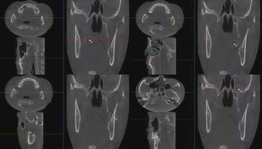 查看报告 口腔CBCT 轴位 牙齿CT 成像高清在线视频素材下载