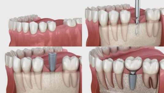种植牙安装、定制基牙和陶瓷冠高清在线视频素材下载