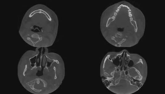 头部CT 牙齿CT 口腔CBCT 轴位成像高清在线视频素材下载