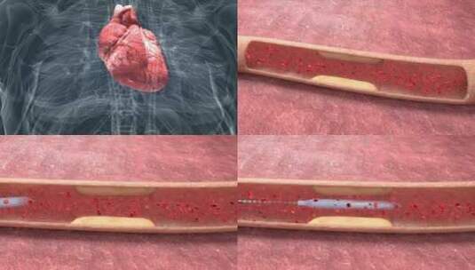 血管堵塞心肌梗塞血管成形术三维动画高清在线视频素材下载