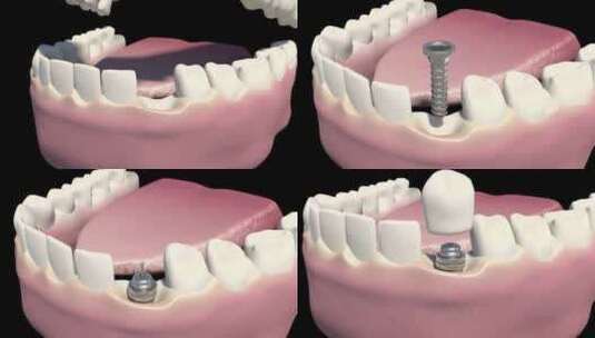 种植牙高清在线视频素材下载