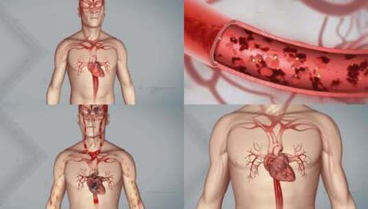 血管堵塞  粥样硬化 脑血栓 血栓 血小板高清在线视频素材下载