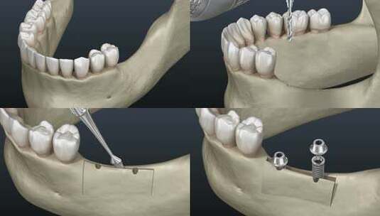 牙槽嵴的劈裂，隆起，植入。高清在线视频素材下载