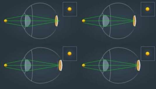 近视眼远视眼视力矫正高清在线视频素材下载