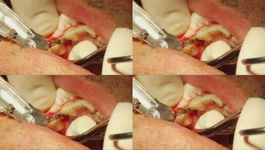牙科手术5高清在线视频素材下载