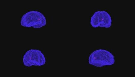 脑瘤 肿瘤 癌症 CT CT检查高清在线视频素材下载