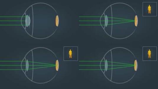 近视眼视力矫正医学人体奥秘三维动画高清在线视频素材下载