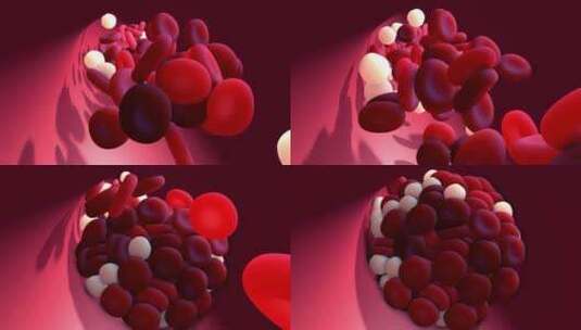 血管堵塞红细胞白细胞高清在线视频素材下载