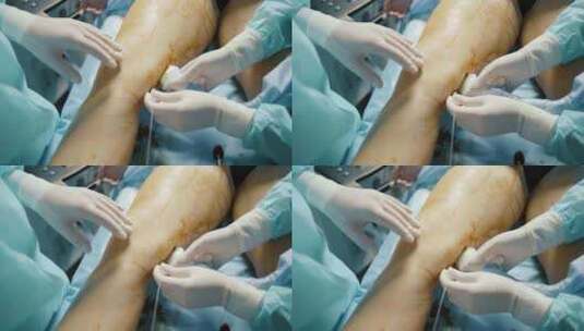 腿部静脉手术高清在线视频素材下载