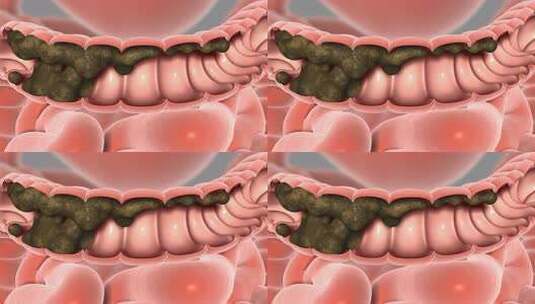 宿便堆积 宿便口臭 肠胃功能紊乱 肠道疾病高清在线视频素材下载