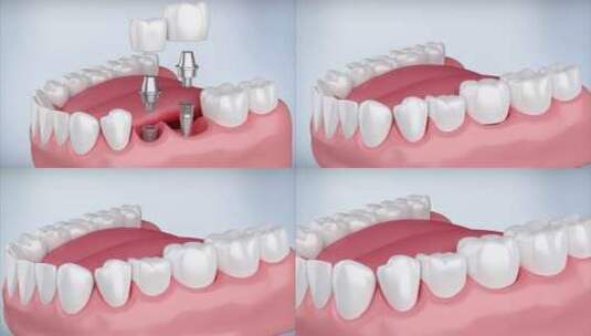 牙医 牙齿 换牙 种植种 植体高清在线视频素材下载
