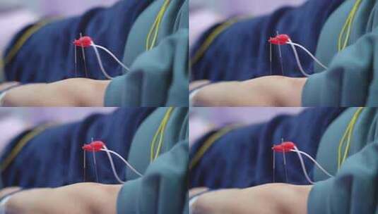 中医电针灸穴位治疗高清在线视频素材下载