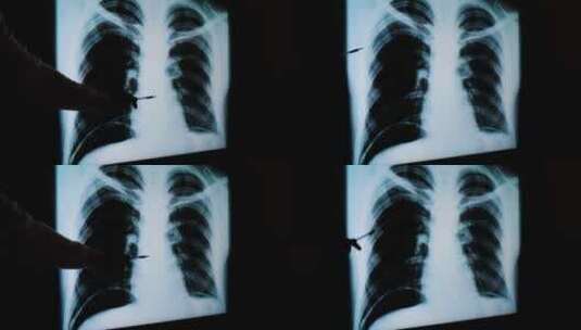 肺部X光片高清在线视频素材下载