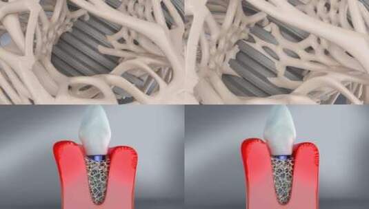 牙齿咬合力 种植牙  牙齿种植体高清在线视频素材下载