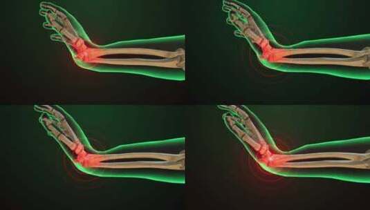 手腕疼痛的动画高清在线视频素材下载