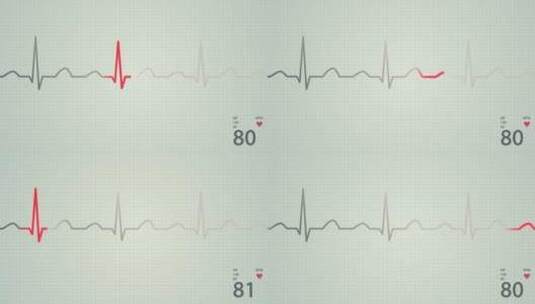 人体心脏正常窦性心律示意图的动画高清在线视频素材下载