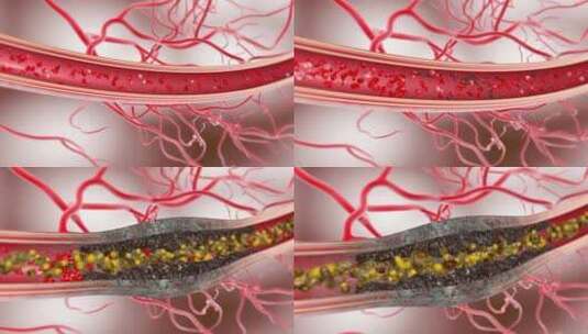 人体血管 血液垃圾堆积 血栓 心脑血管高清在线视频素材下载