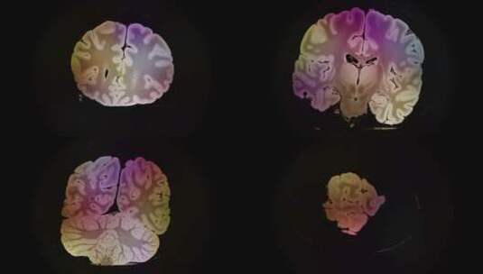大脑热成像高清在线视频素材下载