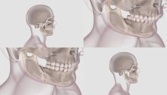 正颌外科下颌高清在线视频素材下载