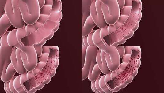 肠道血栓高清在线视频素材下载