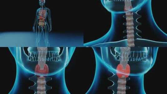 人体结节性甲状腺肿高清在线视频素材下载