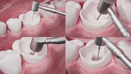 嵌体陶瓷冠安装-医学上准确高清在线视频素材下载