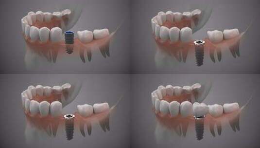 为牙齿植入新的科技高清在线视频素材下载