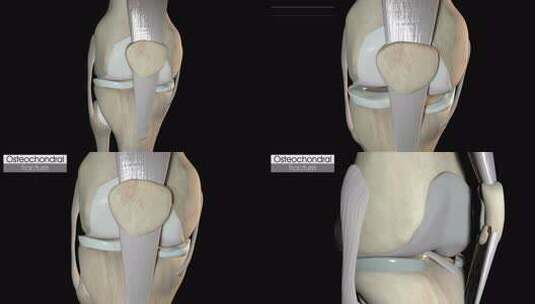髌骨骨折骨软骨高清在线视频素材下载