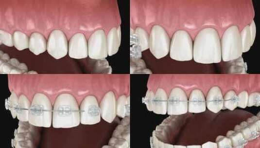 医学口腔牙科牙齿矫正修复3D模拟演示高清在线视频素材下载