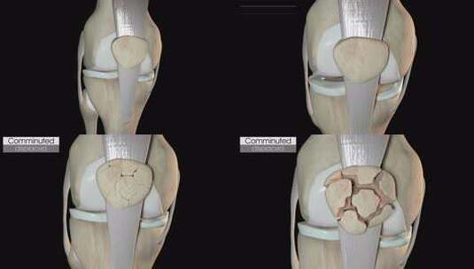 髌骨粉碎性骨折移位高清在线视频素材下载