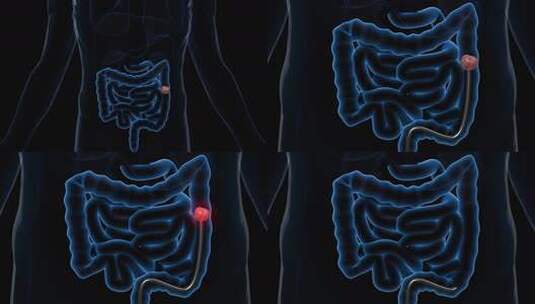 肠梗阻医学疾病高清在线视频素材下载