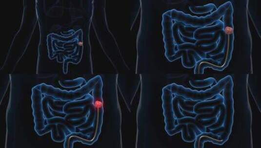 肠梗阻高清在线视频素材下载