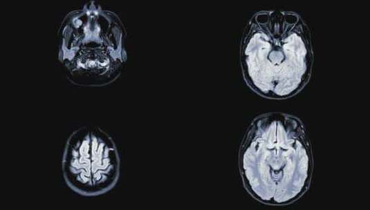 大脑XRAY高清在线视频素材下载