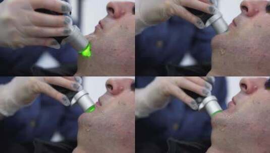 人面部激光脱毛程序治疗高清在线视频素材下载