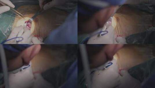 手术中的伤口高清在线视频素材下载