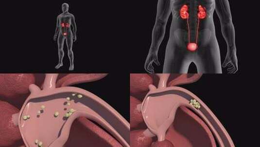 肾结石动画高清在线视频素材下载