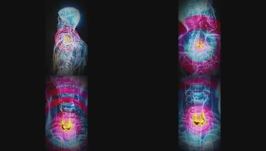 一个人和甲状腺的概念垂直3D动画高清在线视频素材下载
