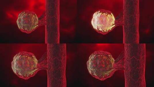 病毒，侵袭性炎症转移癌高清在线视频素材下载