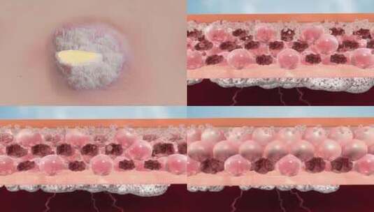 细胞修复 牛皮癣疤痕  疤痕修复 祛疤高清在线视频素材下载