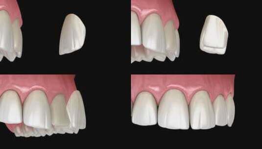 中切牙上的贴面安装程序。高清在线视频素材下载