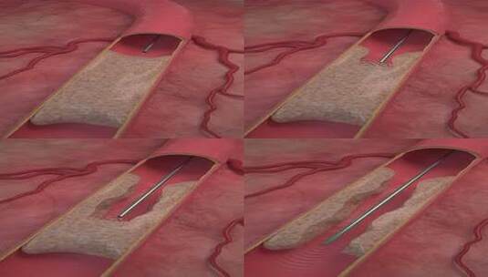 超声波血栓血管钙化血栓去除冠状动脉钙化高清在线视频素材下载